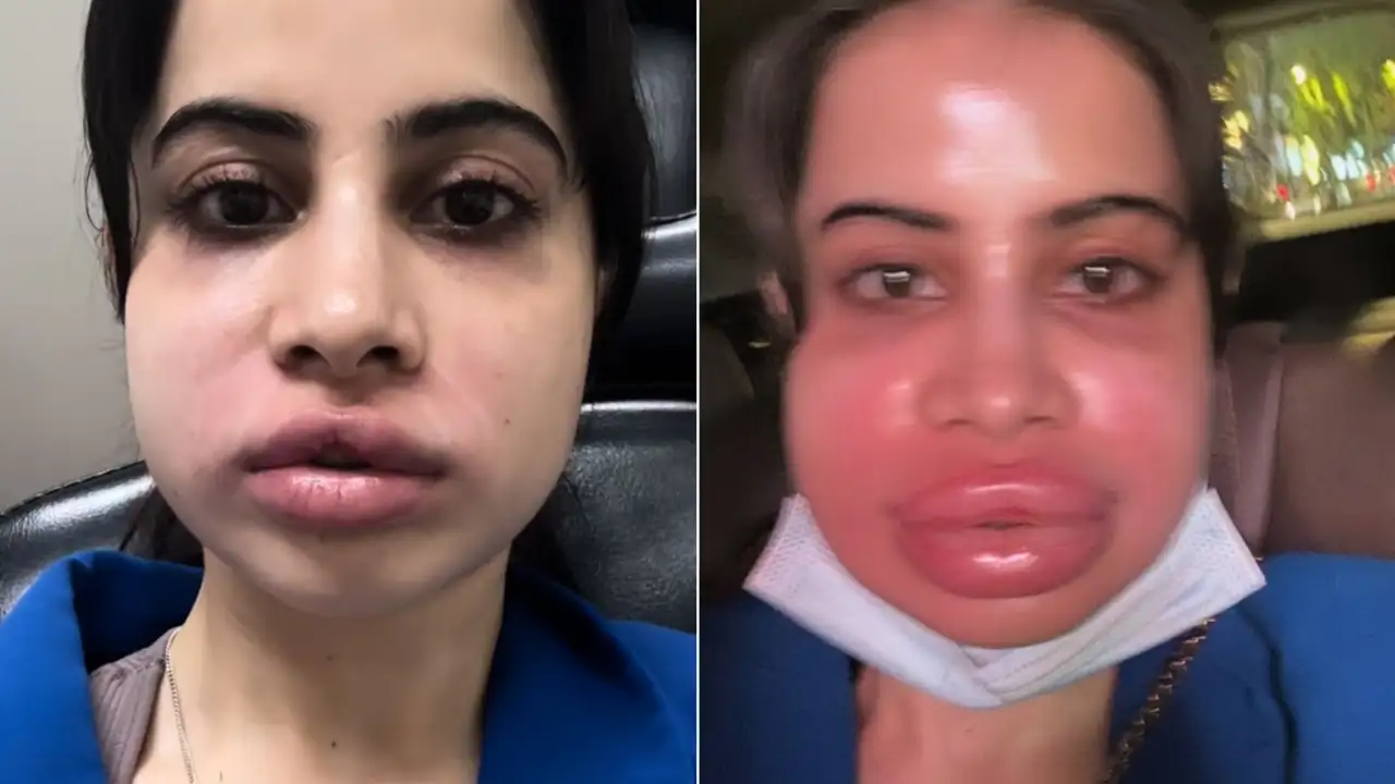 Urfi Javed Undergoes Procedure To Dissolve Lip Filler, Shares Shocking Video Of Swollen Face