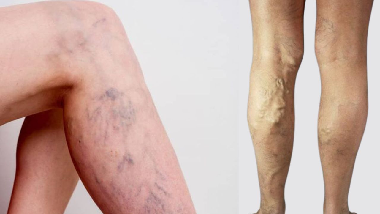 Bulging Veins in Your Legs May Signal Major Health Problems!