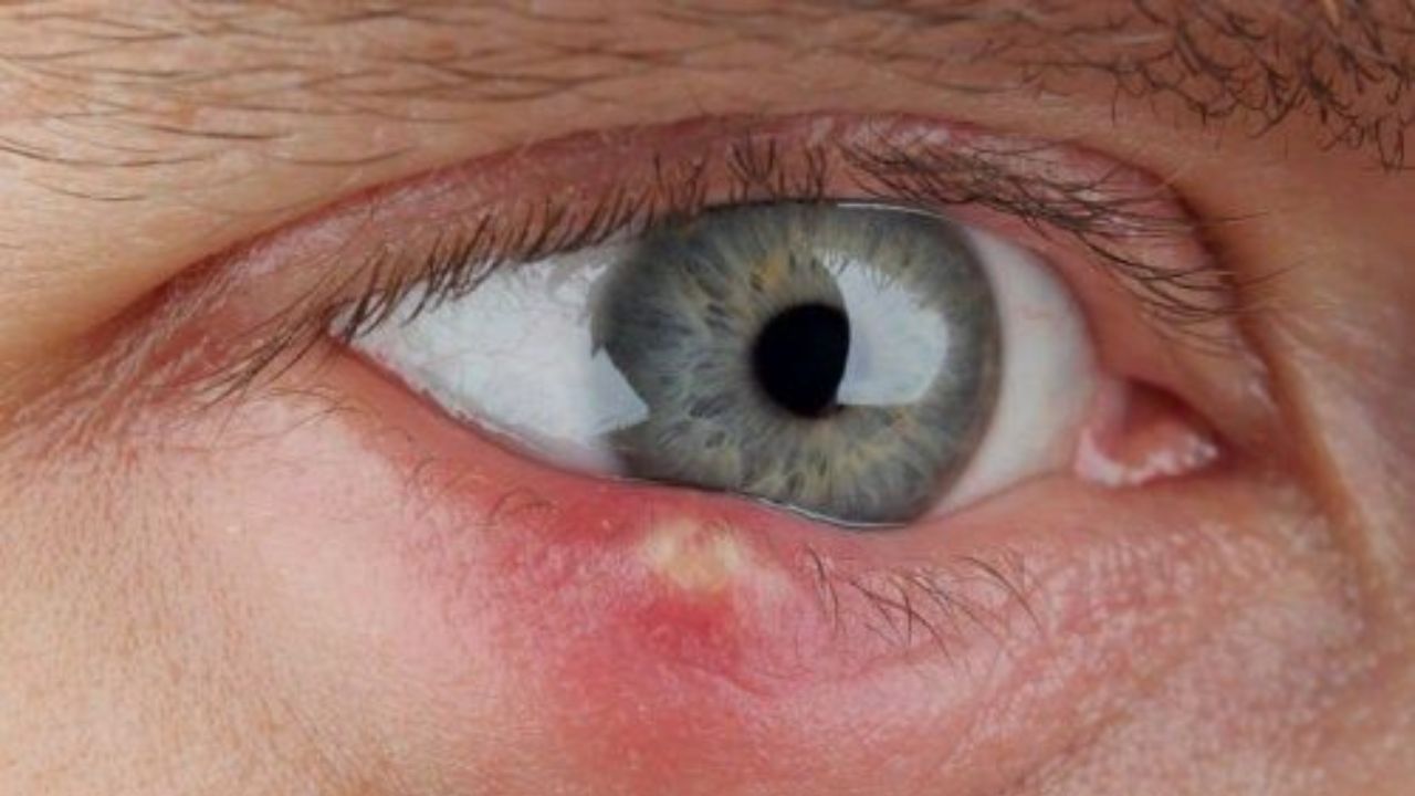 Problems Caused by Excessive Eyelashes – Stay Careful