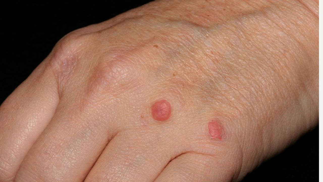 What Causes Small Lumps on the Body? Remedies Explained