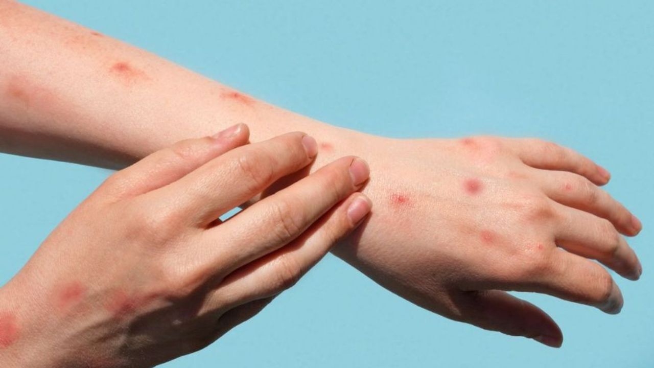 Tomato Flu Symptoms in Children – Delay Can Be Dangerous