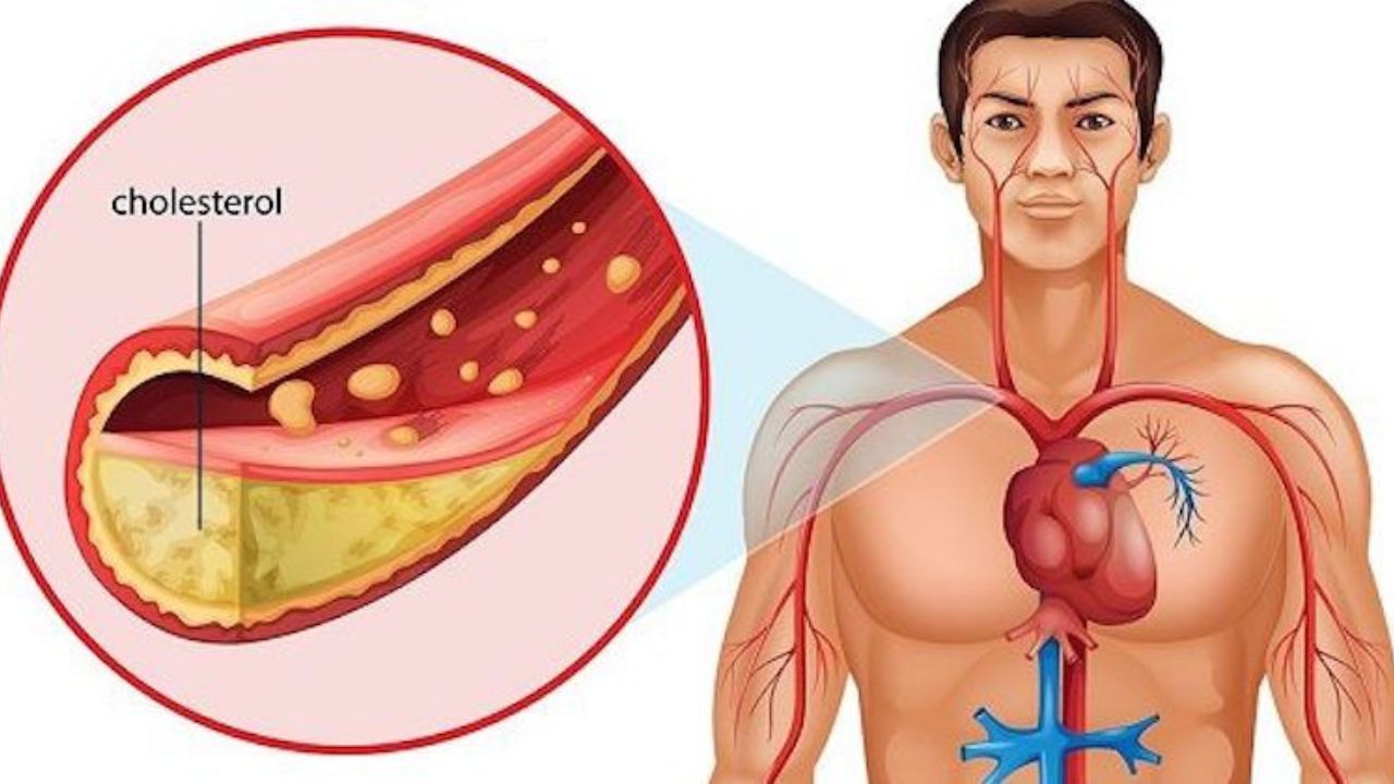 Small Eating Mistakes That Lead to “Dirty Cholesterol” Problems