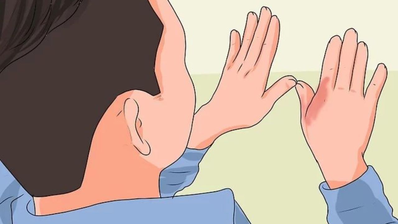 Diwali Accident? What You Need to Know About Applying Ice to Injuries