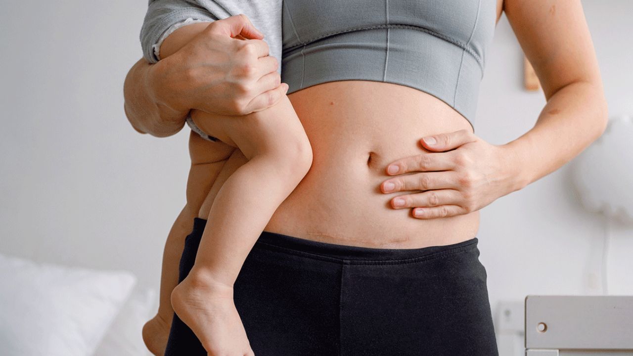 Essential Post-C-Section Care Every New Mom Should Know