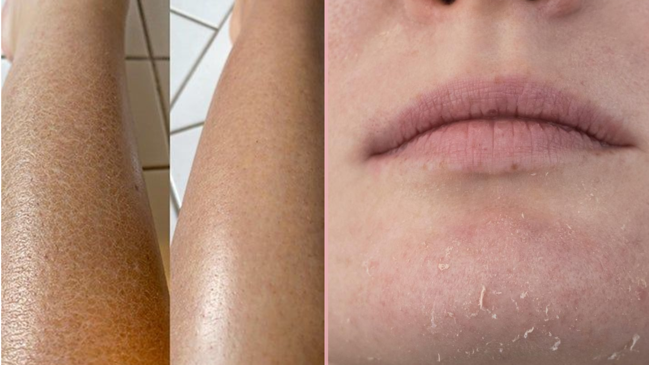 Why Cold Weather Dries Your Skin: Causes and Solutions