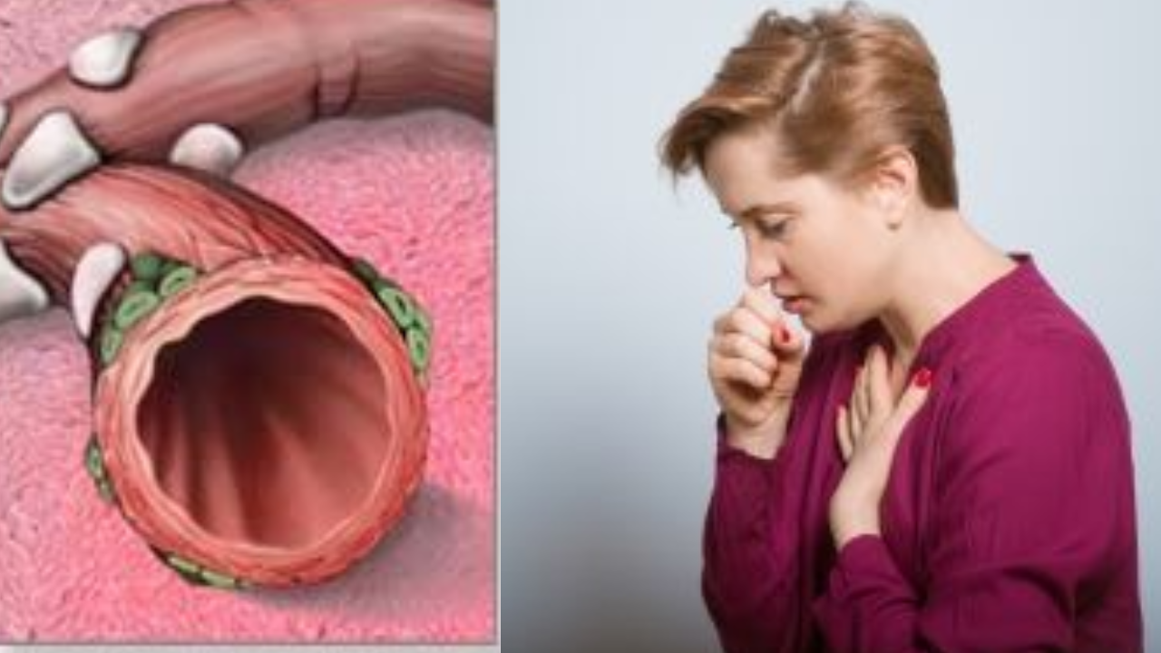 Bronchitis Relief Starts in Your Plate: Cut These Foods Immediately