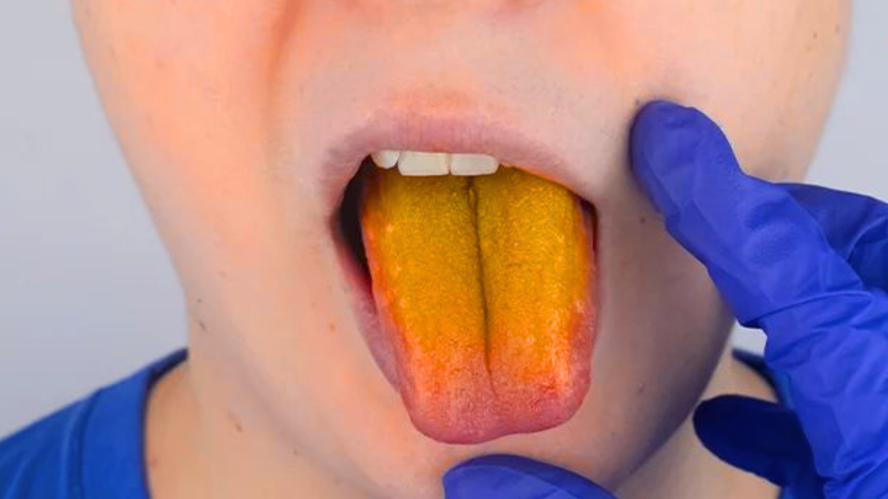 Tongue Color Changes: What Your Body Is Trying to Tell You