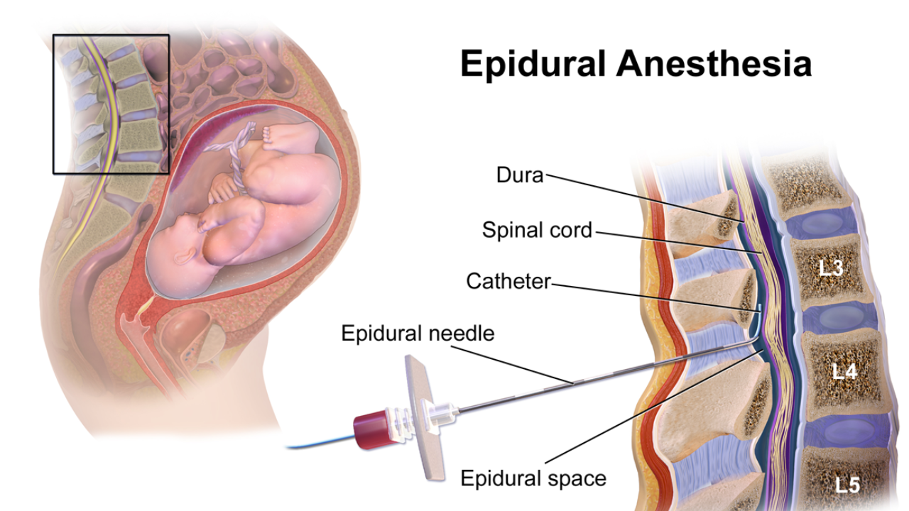 Epidural During Childbirth: How Safe Is It? Pros, Cons and Care Tips