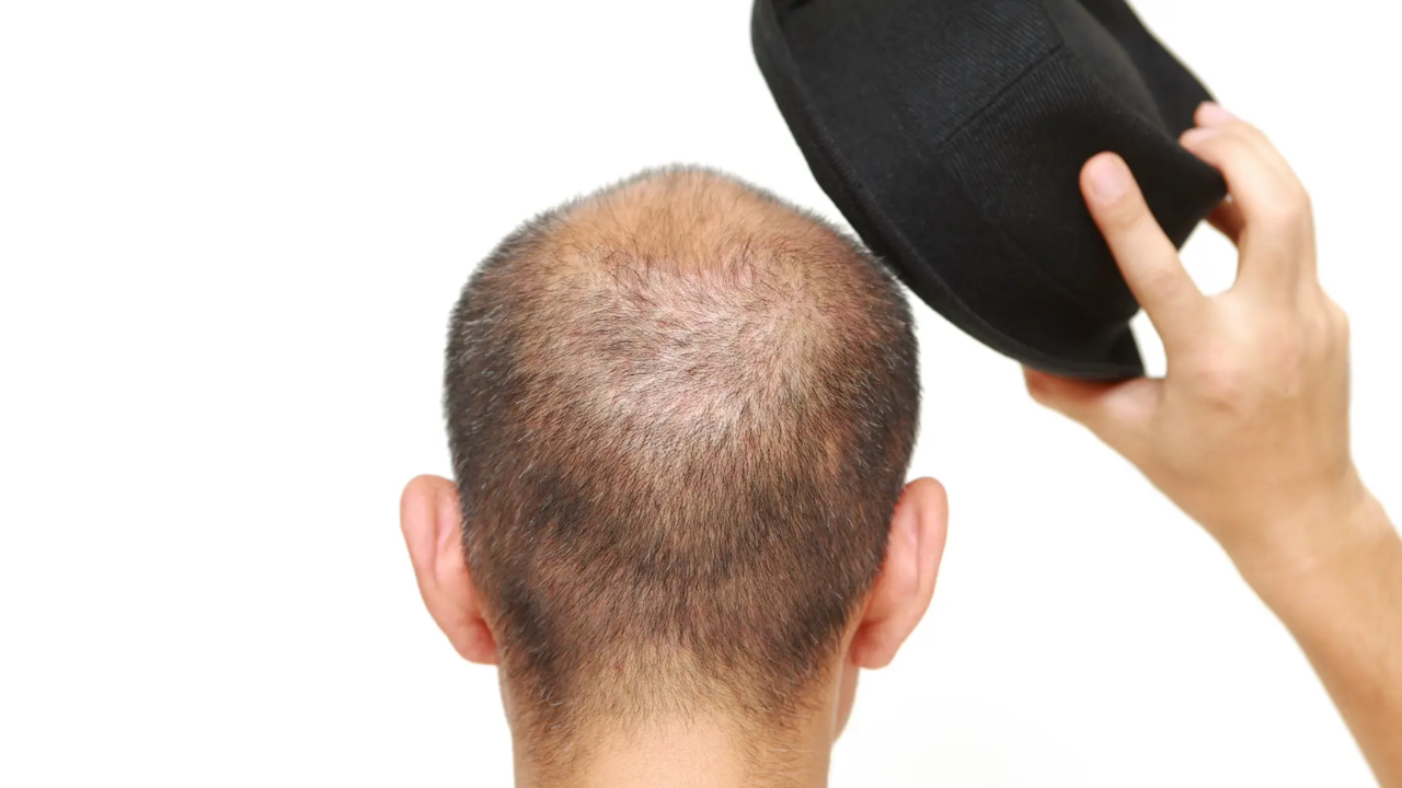 Wearing a Helmet Causes Hair Fall? Here’s What Experts Actually Say