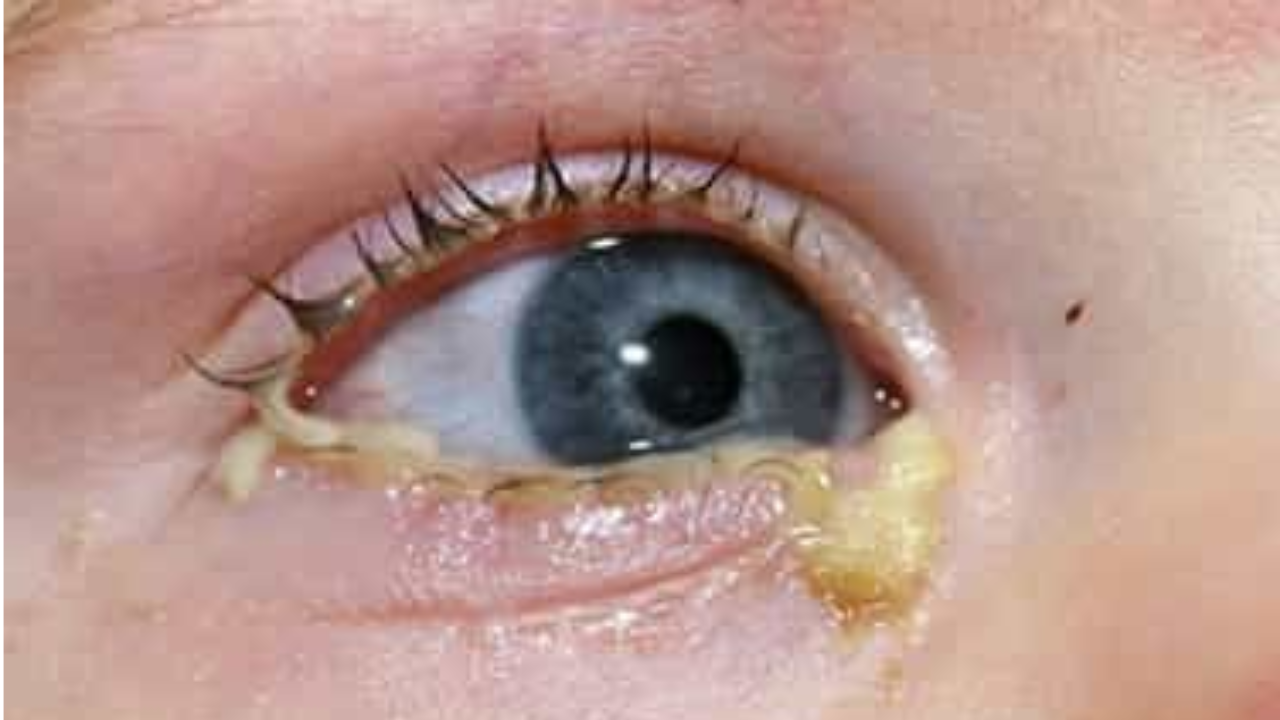 Eye Mucus Removal Habit: Serious Side Effects You Shouldn’t Ignore
