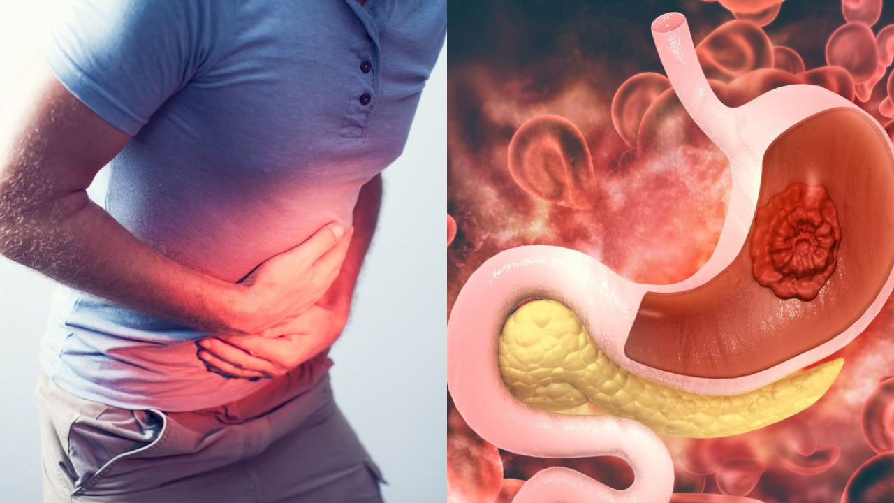 Common Habits That Can Lead to Ulcers – Stay Alert!