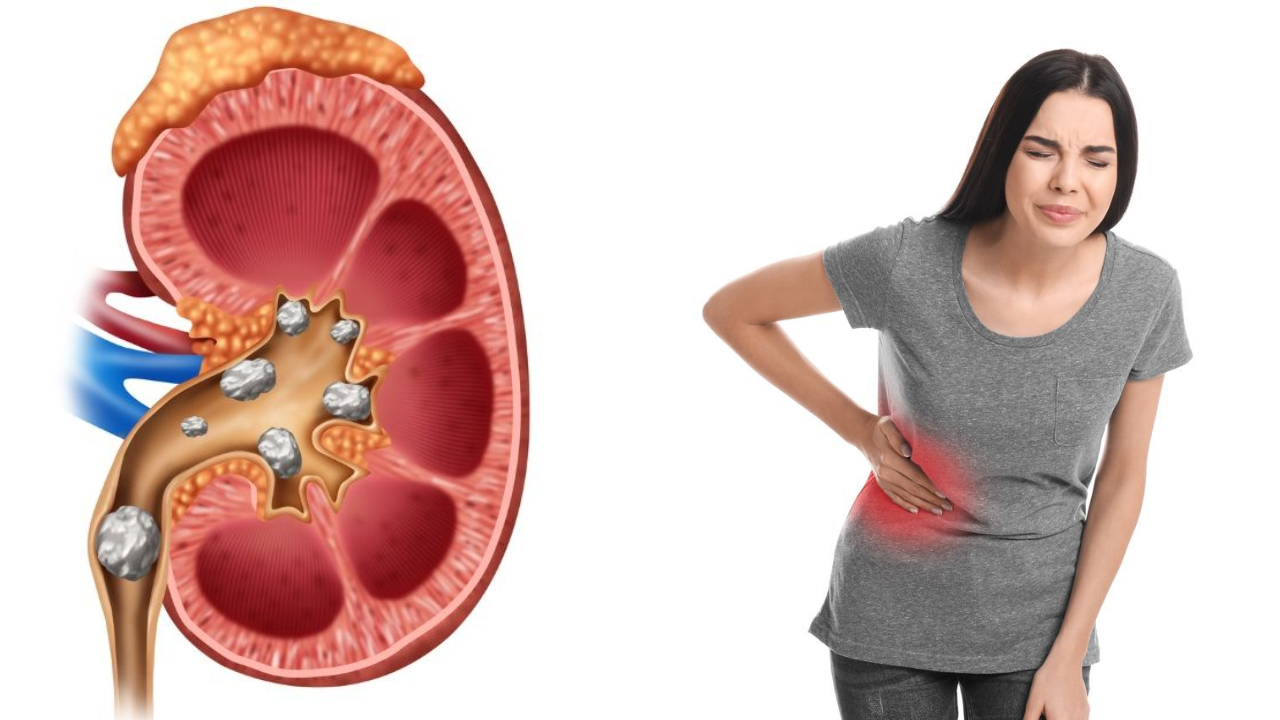 Can Kidney Stones Return After Surgery? Doctors Reveal the Real Truth