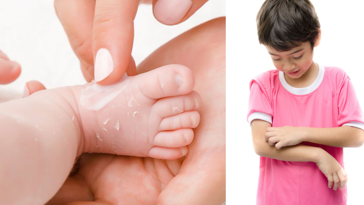 Winter Dry Skin in Kids: Hidden Reasons and Simple Precautions