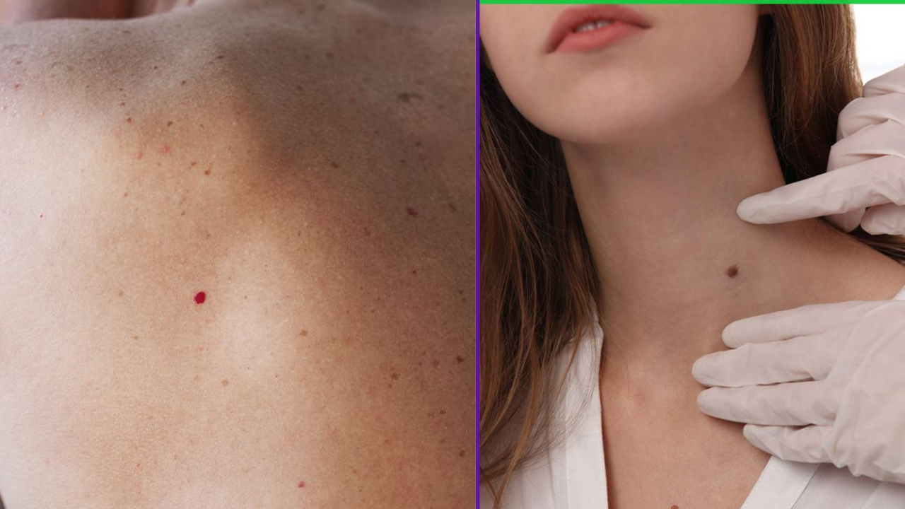 Blue Marks on Skin: Causes You Shouldn’t Ignore