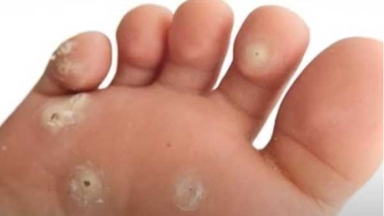 How to Get Rid of Dark Circles Naturally – Expert Advice