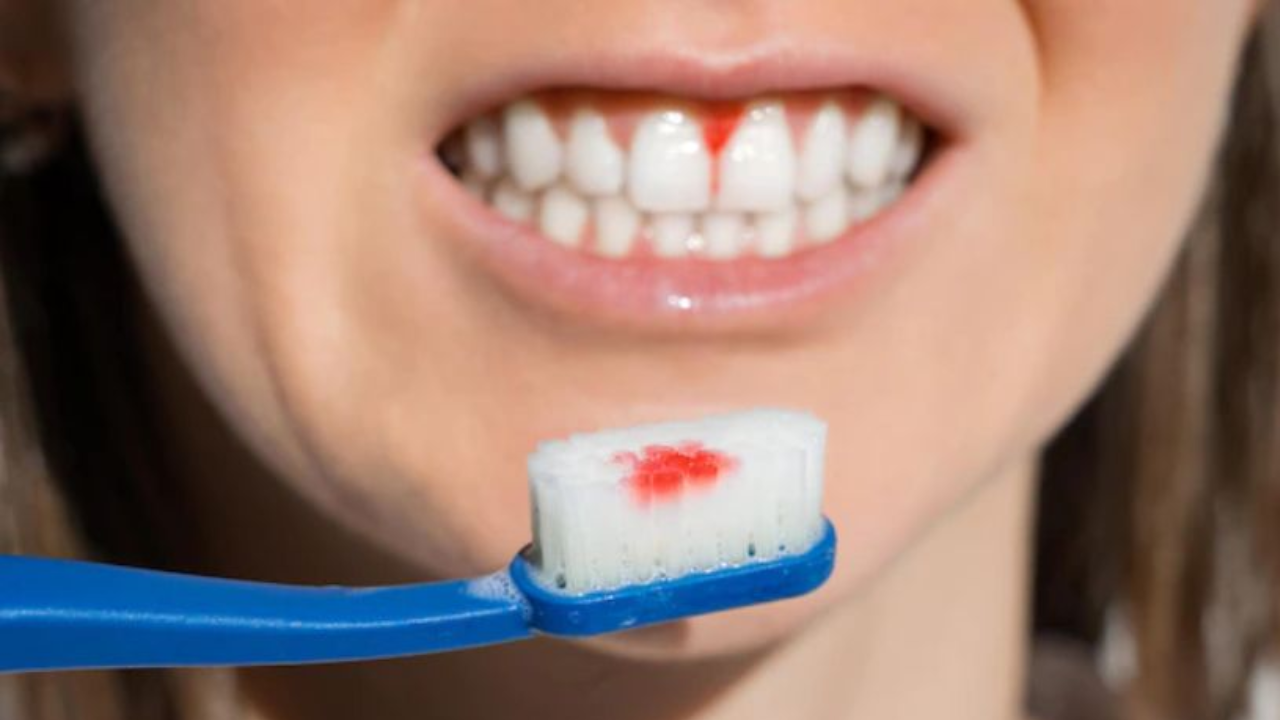 Gum Bleeding: Warning Signs You Shouldn’t Ignore About Your Health