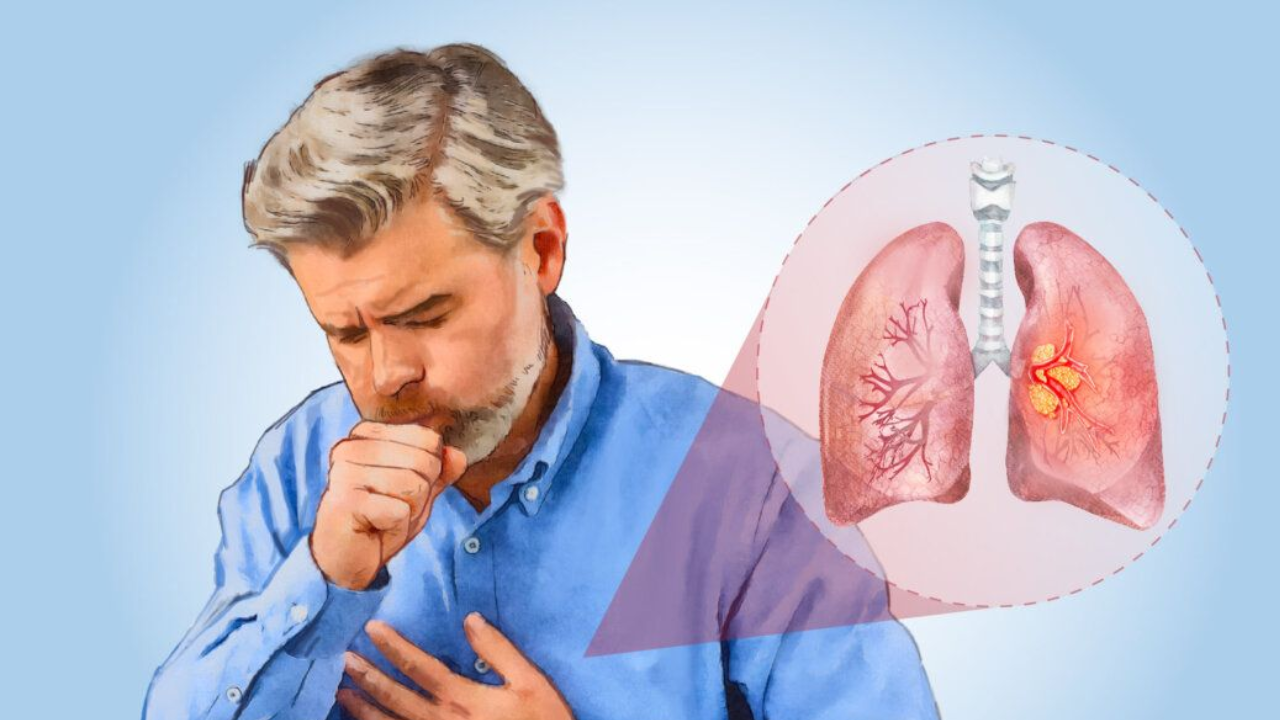 Lung Cancer in Non-Smokers Is Increasing: Awareness Is Crucial