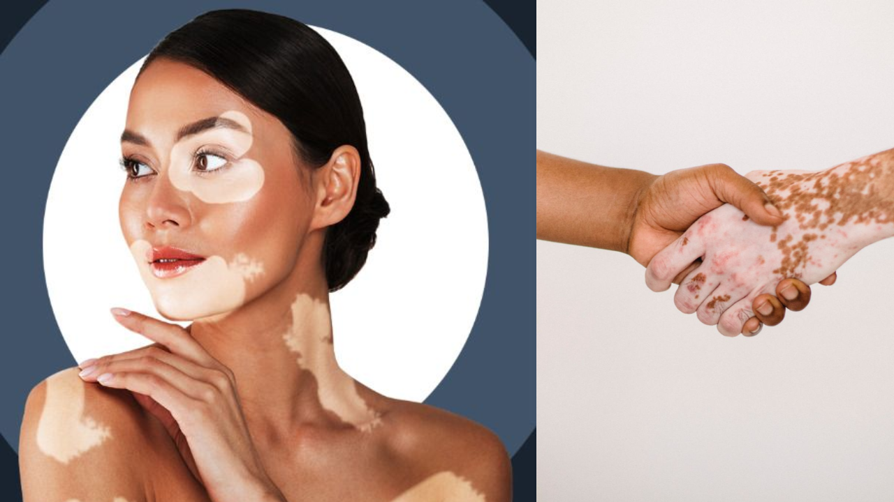 White Spots on the Body? It’s Not Always Vitiligo