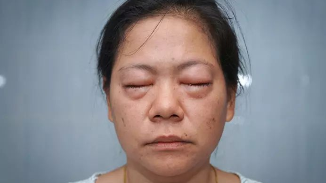 Facial Swelling Alert: Early Symptom of Kidney Issues You Shouldn’t Miss