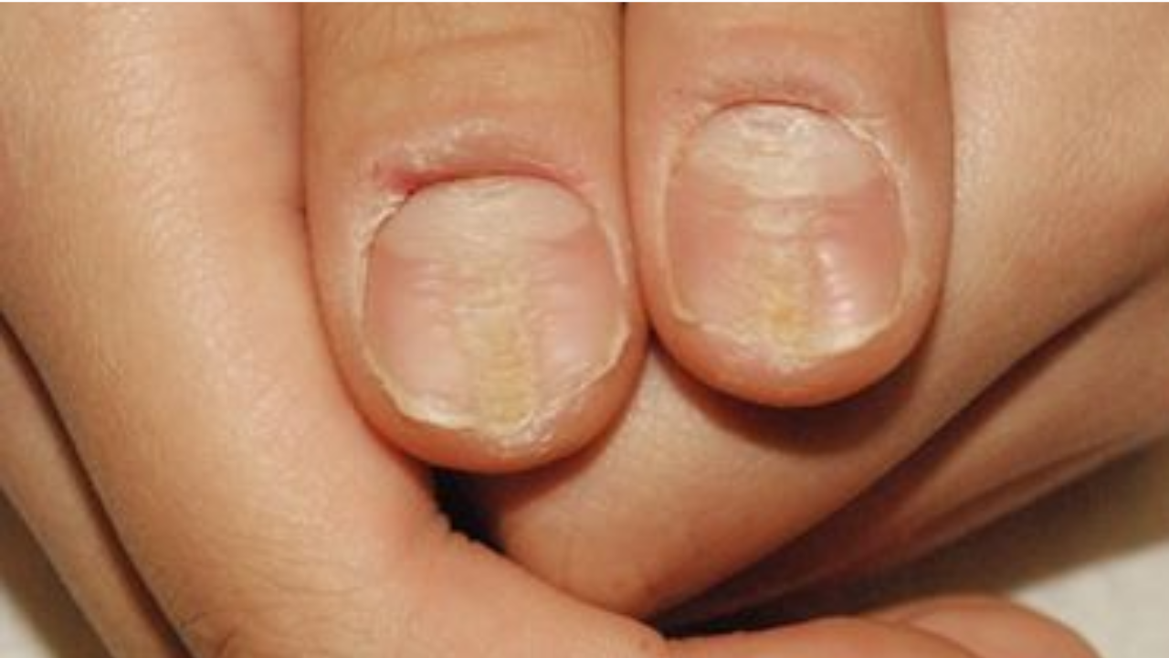 White Spots on Nails: Is It Really Calcium Deficiency?