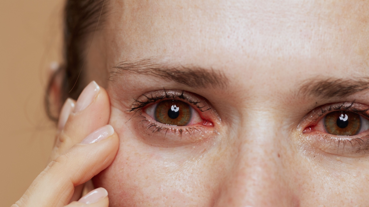 Burning or Dry Eyes in Summer? Don’t Ignore These Warning Signs!