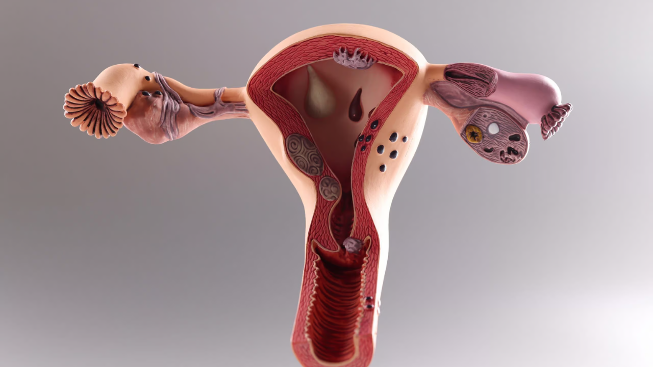 Adenomyosis Explained: Warning Signs Every Woman Must Know