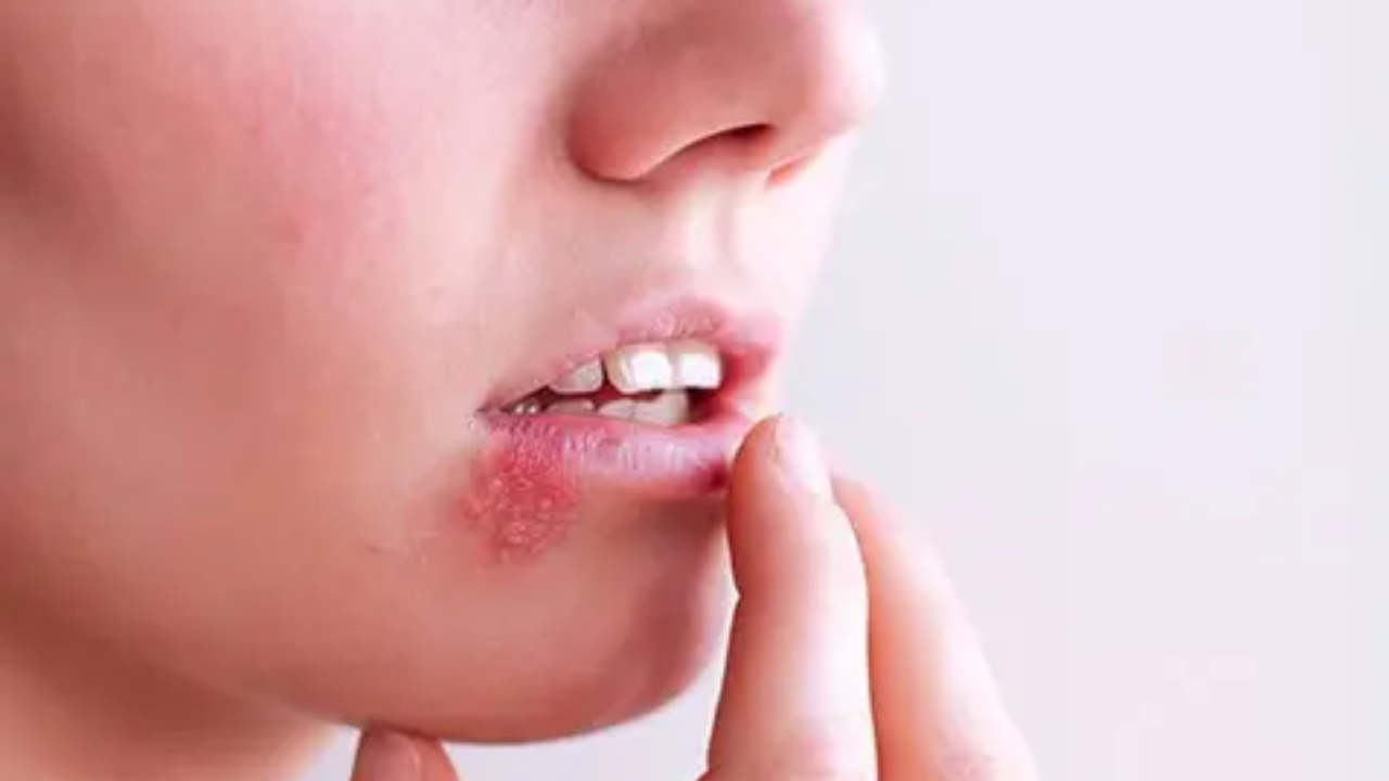 Kissing Disease Explained: Ignoring It May Lead to Nerve Damage