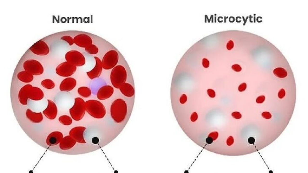 Microcytic Anemia Alert: Is Your Body Lacking Oxygen?