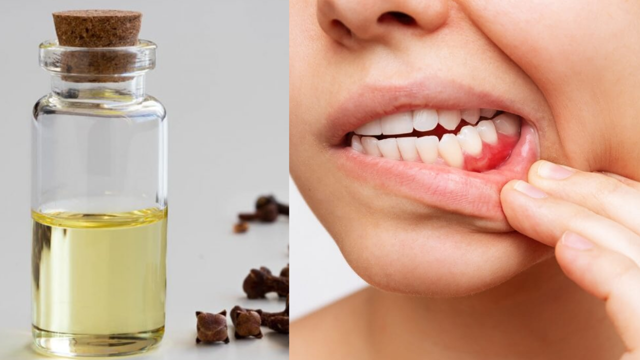 Say Goodbye to Gum Issues and Bad Breath with Clove Oil