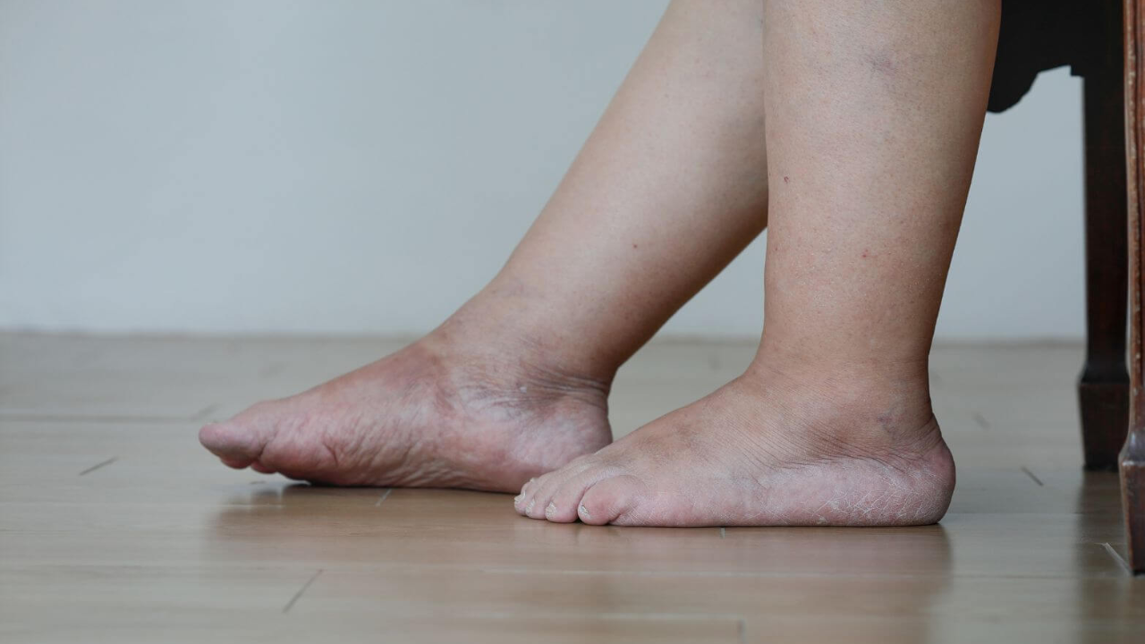 Unexplained Leg Swelling & Pain? Don’t Ignore These Warning Signs