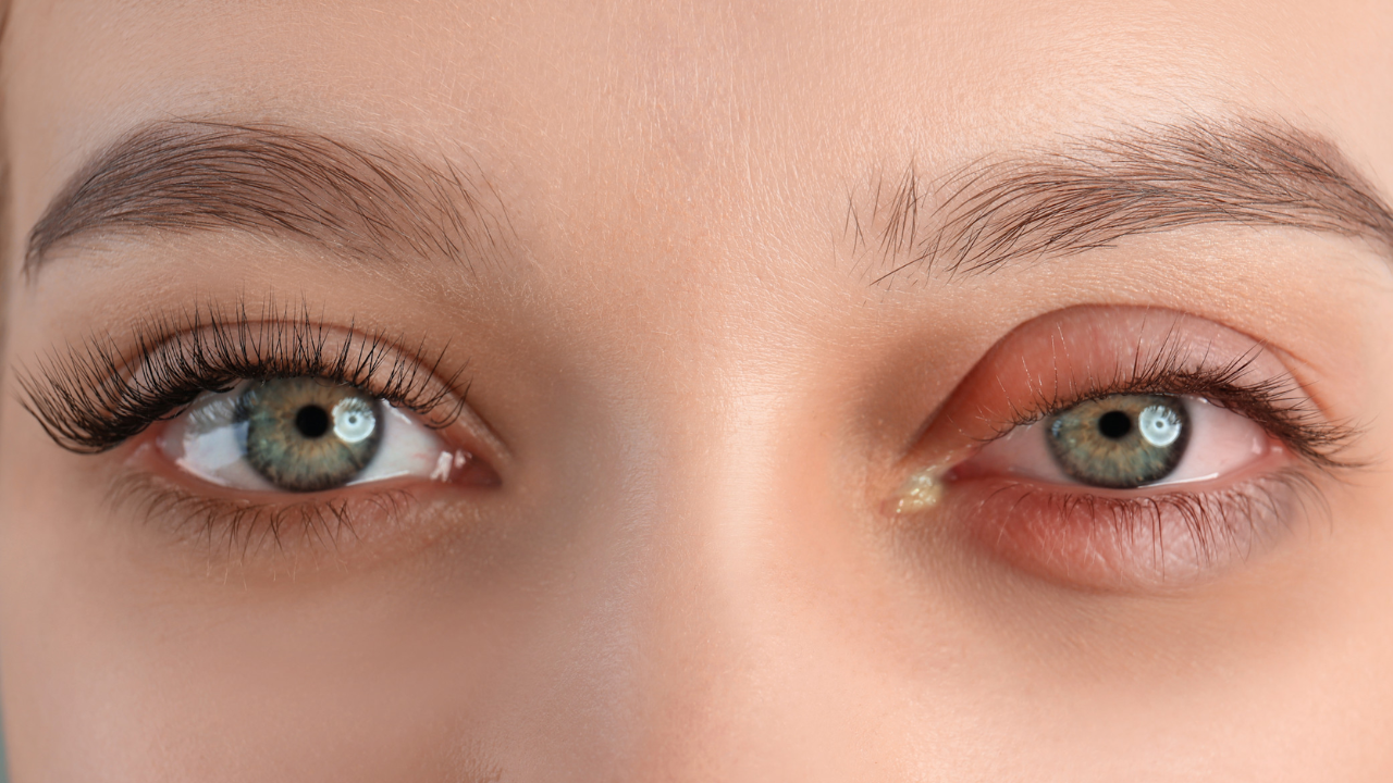 Eye Swelling Not Going Away? Causes, Remedies & When to Worry